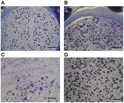 Distinct features of hypereosinophilic syndrome with neuropathy from eosinophilic granulomatosis with polyangiitis